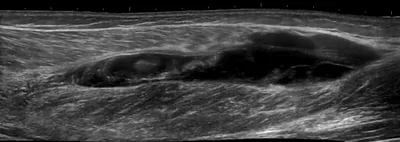 Medial gastrocnaeumius tear + intramuscular haematoma
