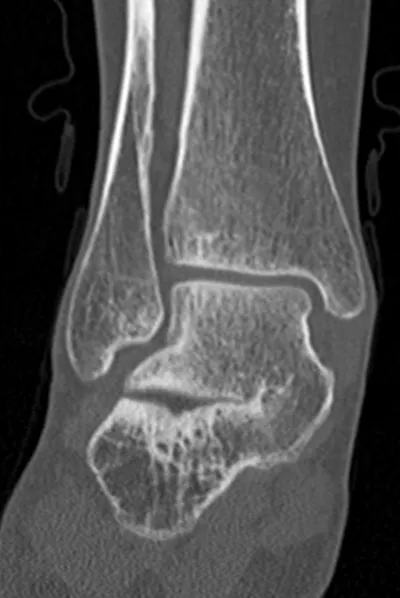 Talocalcanceal tarsal coalition