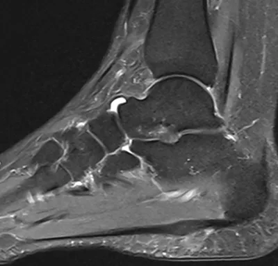 Mid plantar fasciitis
