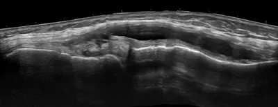 Large parameniscal cyst