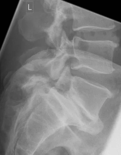 Spondylolisthesis due to pars defects